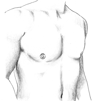 After Male Chest Contouring Surgery