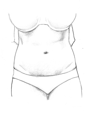 After Liposuction Surgery