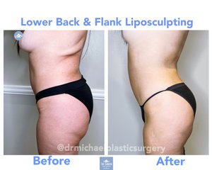 Upper and Lower Abdomen and Flank Liposuction, Inner and Outer Thigh  Liposuction with Fat Transfer to Buttocks - Terrell Clinic