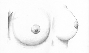 After Breast Augmentation Surgery