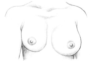 Before Breast Implant Revision Surgery